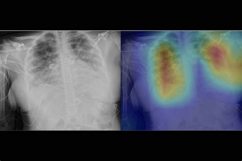 Radiologists use deep learning to find signs of COVID-19 in chest X ...