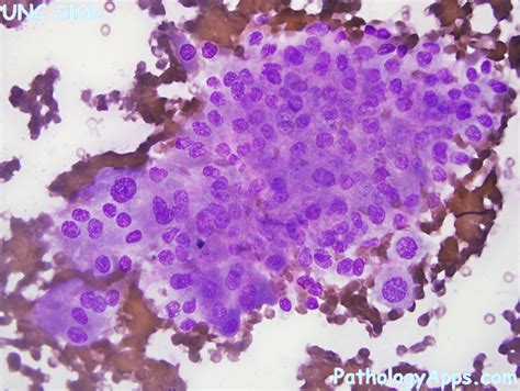 oncocytoma salivary gland cytology