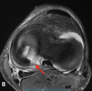 Meniscal Root Tears | Knee Specialist | Minnesota