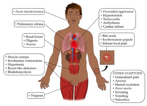 Local and systemic clinical manifestations of latrodectism. | Download Scientific Diagram