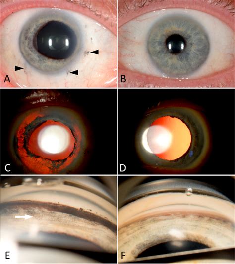 Unilateral acute iris transillumination, clinical findings. A, The ...