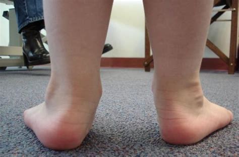 Overpronation: Causes, treatment, and exercises