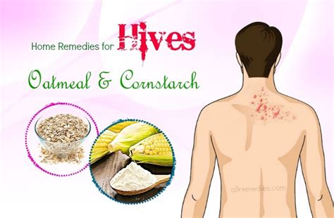 Top 16 Natural Home Remedies For Hives On Face And Body