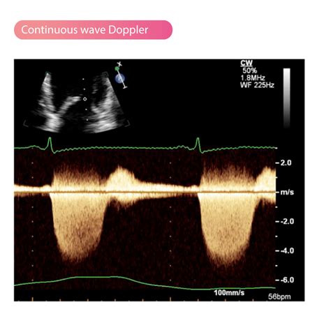 Continuous Wave Doppler (CW Doppler) – Cardiovascular Education