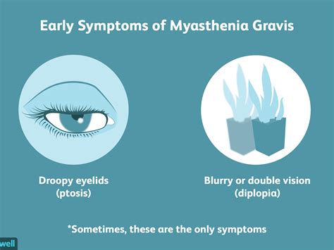 Myasthenia gravis – Dentowesome