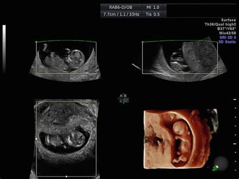 Ultrasound in the First Trimester and Earlier: How to Keep It Safe | Radiology Key