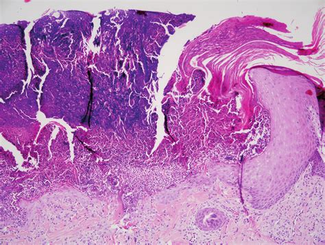 Histological findings in umbilicated prurigo. Epidermal depression ...