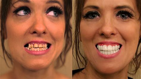 Removable Porcelain Veneers | Brighter Image Lab Official Blog