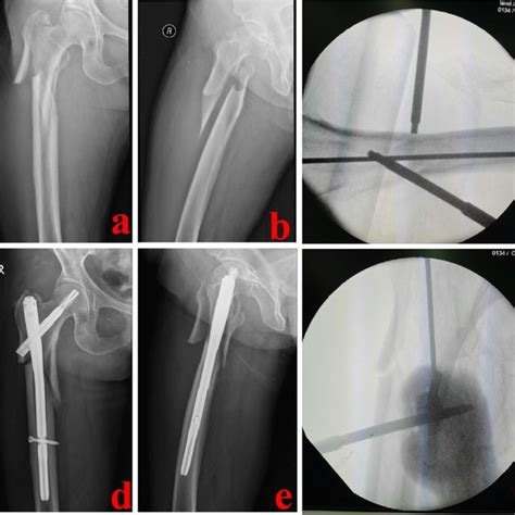 A 47-year-old male suffered from an extracapsular hip fracture and was... | Download Scientific ...