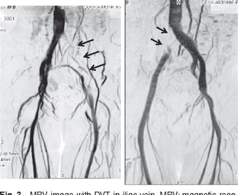 Figure 2 from MR Venography for the Assessment of Deep Vein Thrombosis ...