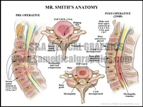 Neurosurgical Complications - S&A Medical Graphics