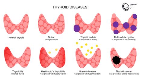 Lump In Throat Thyroid