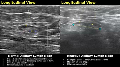 Axillary Lymph Nodes Ultrasound Normal Vs Abnormal Images With Doppler | Reactive & Malignant ...