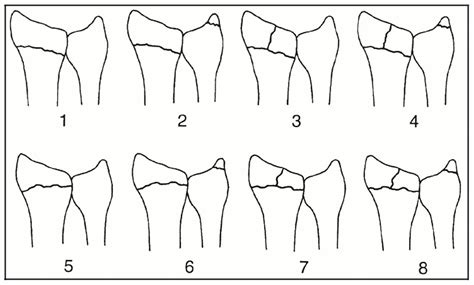 Distal Radius Fractures Trauma Orthobullets 3225 | The Best Porn Website