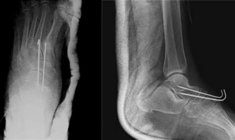 Post-operative radiograph. DISCUSSION Mid tarsal joint dislocations are ...