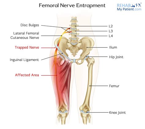 Femoral Nerve Entrapment | Rehab My Patient