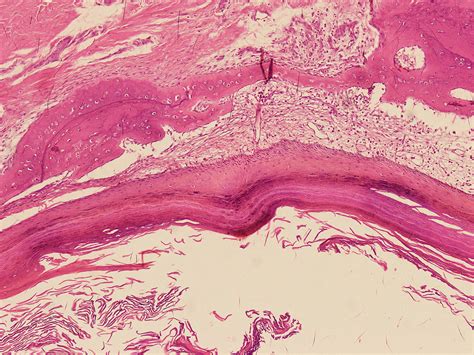 Epidermal Inclusion Cyst Histology