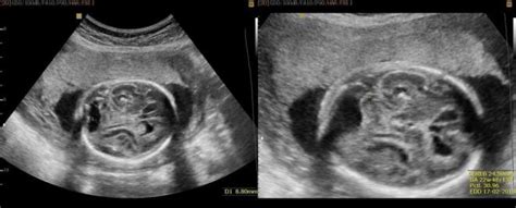 36 Weeks Pregnant Ultrasound