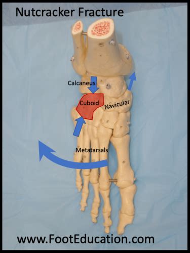 Cuboid Impaction (Nutcracker) Fracture - FootEducation