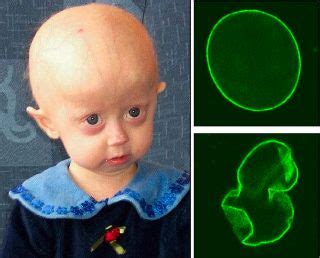 Hutchinson-Gilford Progeria Syndrome. These children give the distinct physical impression of ...
