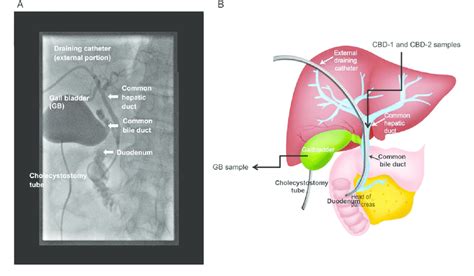 Percutaneous Transhepatic Drainage Of Gallbladder - Best Drain Photos Primagem.Org