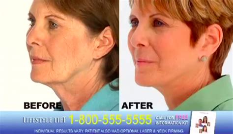 One-Hour Facelift Company Lifestyle Lift Abruptly Closes, Considering Bankruptcy – Consumerist