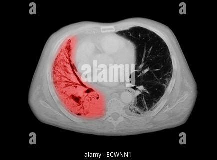 CT scan of the chest showing pneumonia Stock Photo - Alamy