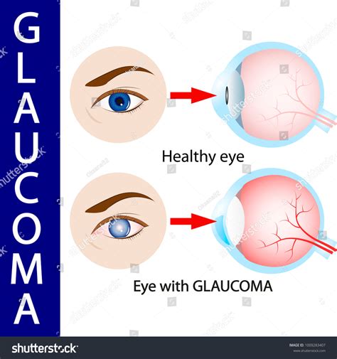 Glaucoma Eye Pressure Optic Nerve Blindness Stock Vector (Royalty Free) 1009283407 | Shutterstock