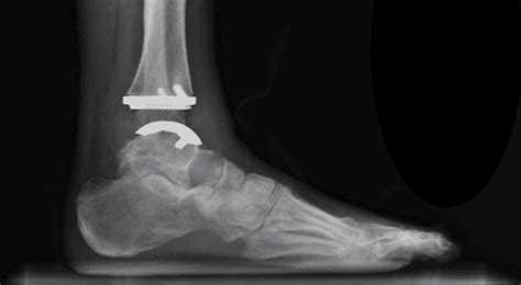 Ankle Replacement Recovery Made Easy : Phoenix Foot and Ankle Institute: Foot and Ankle Specialists