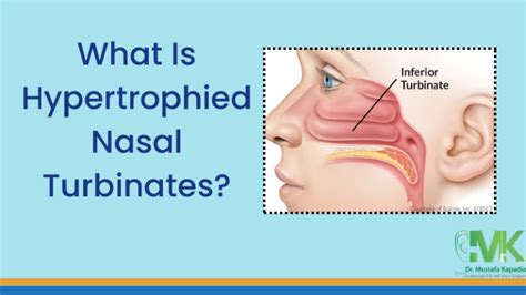 Hypertrophied Nasal Turbinates | Nasal Turbinates