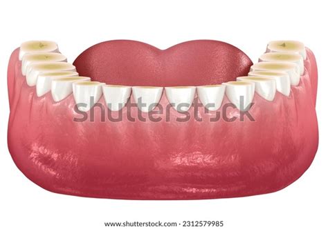 400 Dental Erosion Images, Stock Photos & Vectors | Shutterstock