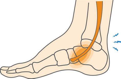 What is Posterior Tibial Tendonitis & How to Relieve Foot Pain? - Upswing Health