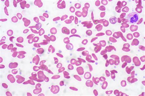 Sickle Cell Disease (Clinical) | Concise Medical Knowledge