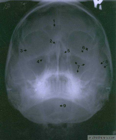 Fracture maxilla pptx - Dr.Wafaa - Muhadharaty