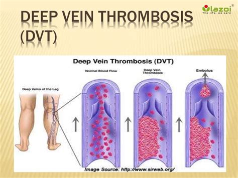 Deep vein thrombosis dvt