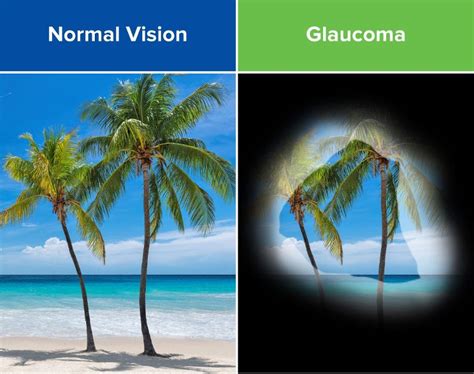 Glaucoma | Causes, Symptoms, & Treatments | Acuity Eye Group