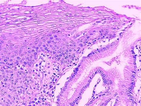 Gastroesophageal Junction Slide Labeled