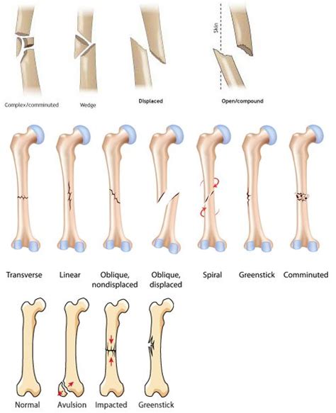 골절(Fracture, Fx.) 골절의 정의와 종류 : 네이버 블로그