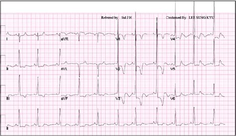 Abnormal 12 Lead Ecg