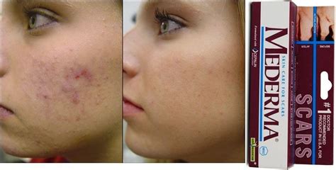 Acne Scars Before And After Mederma