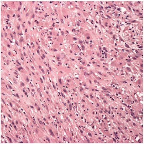 Epithelioid Sarcoma-Like Hemangioendothelioma | Basicmedical Key