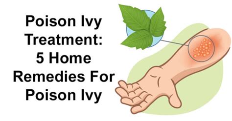 Poison Ivy Treatment: 5 Home Remedies For Poison Ivy - David Avocado Wolfe