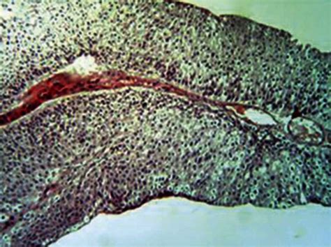 Low‑grade papillary urothelial carcinoma of the bladder H and E (×10 ...