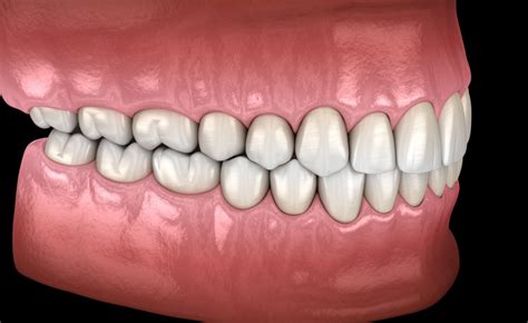 Occlusal Adjustments - New London, CT - Westerly, RI | Shoreline ...