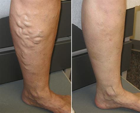 Spider vein Treatment: Which One To Choose Sclerotherapy Or Compression Stockings?