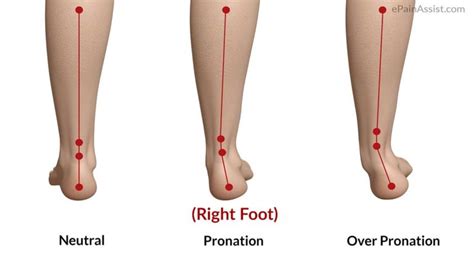 Foot Pronation: Underpronation & overpronation explained- The Foot Clinic