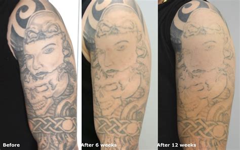 Top Tattoo Art: How Many Sessions of Laser Tattoo Removal