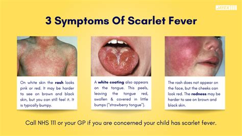 Strep A and Scarlet Fever Information - Munro Medical Centre