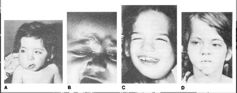 HEMIFACIAL HYPERPLASIA | Semantic Scholar