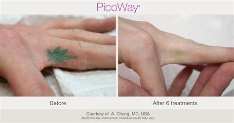 PicoWay Laser Tattoo Removal – Synergy Medical Aesthetics – Nanaimo, Victoria, Vancouver Island